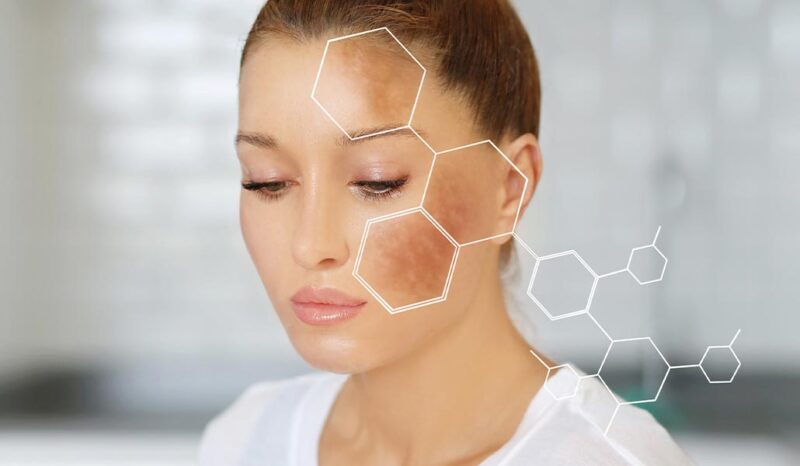 image of woman with hyperpigmentation